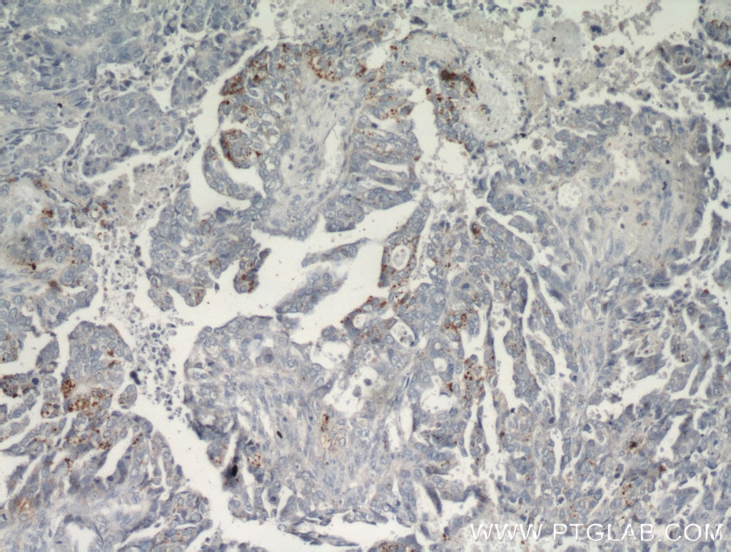 Immunohistochemistry (IHC) staining of human ovary tumor tissue using CHI3L1/YKL40 Polyclonal antibody (12036-1-AP)