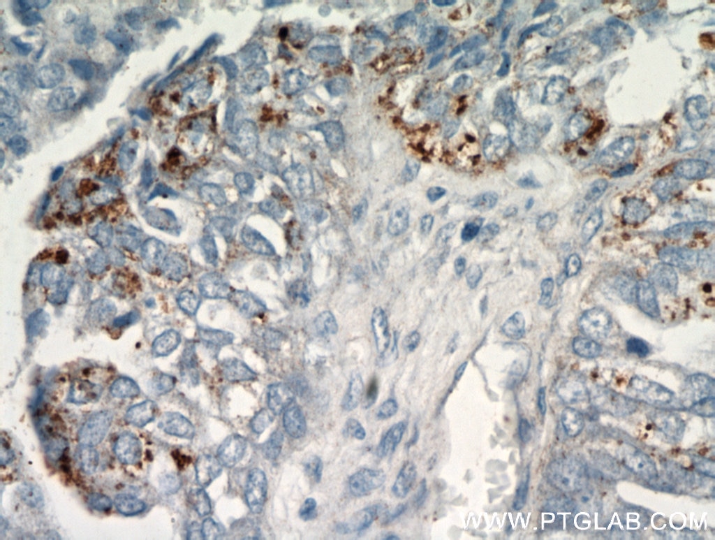Immunohistochemistry (IHC) staining of human ovary tumor tissue using CHI3L1/YKL40 Polyclonal antibody (12036-1-AP)