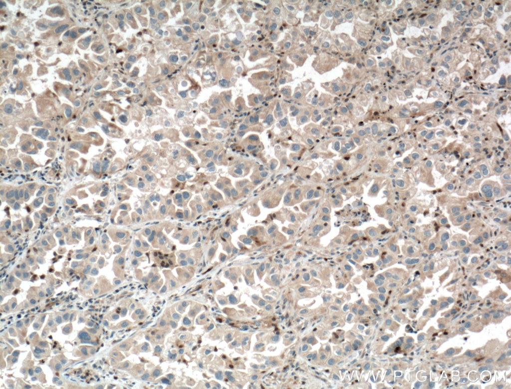 Immunohistochemistry (IHC) staining of human lung cancer tissue using Chk1 Polyclonal antibody (10362-1-AP)