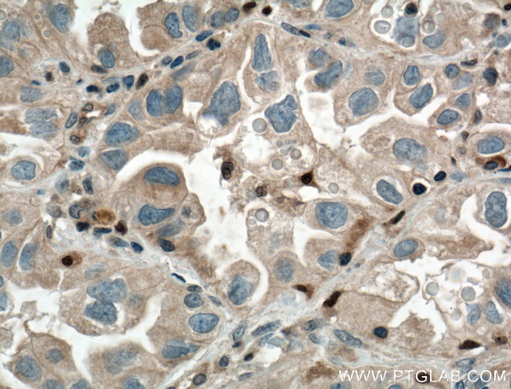 Immunohistochemistry (IHC) staining of human lung cancer tissue using Chk1 Polyclonal antibody (10362-1-AP)