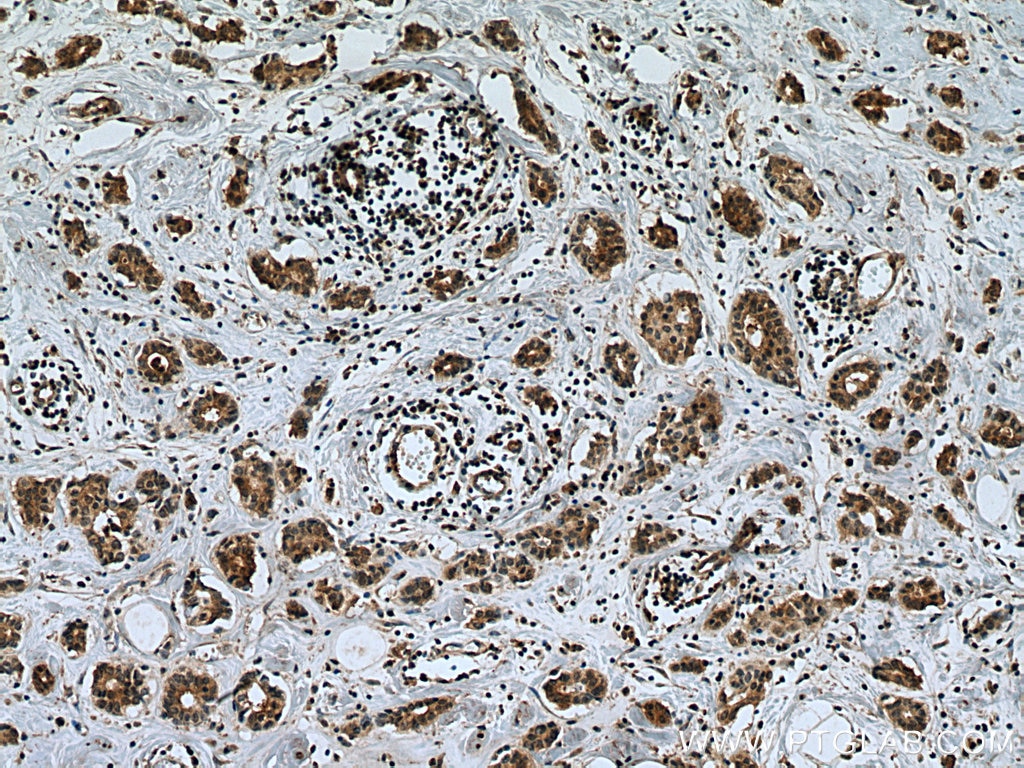Immunohistochemistry (IHC) staining of human breast cancer tissue using Chk1 Monoclonal antibody (60277-1-Ig)