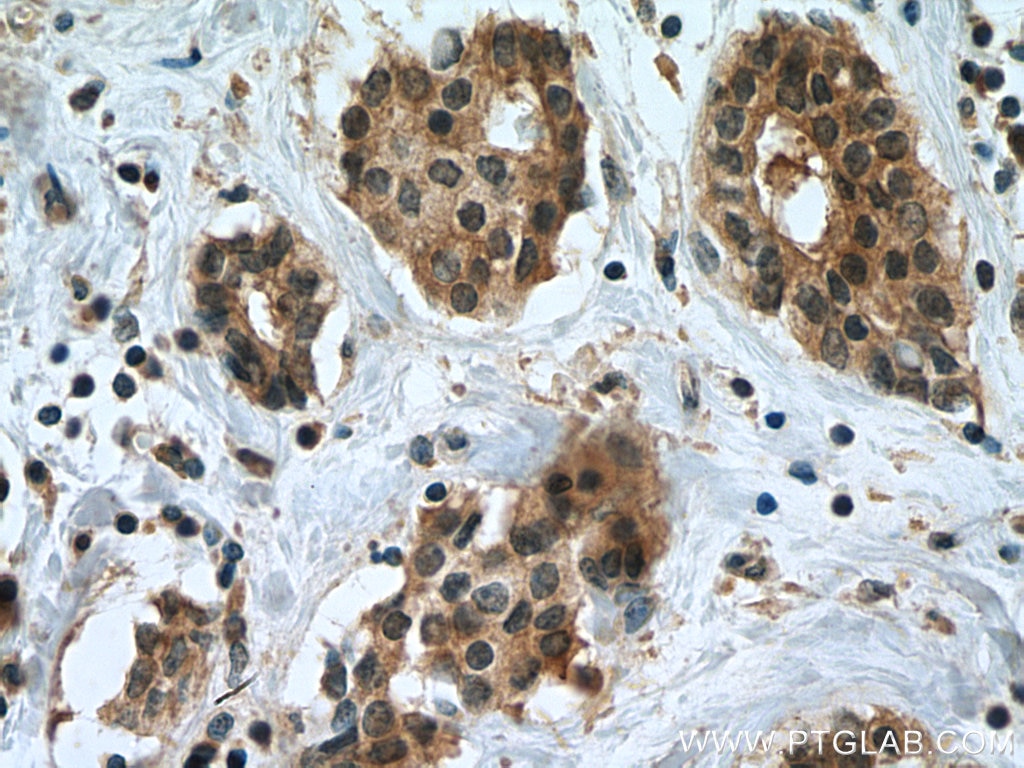 Immunohistochemistry (IHC) staining of human breast cancer tissue using Chk1 Monoclonal antibody (60277-1-Ig)