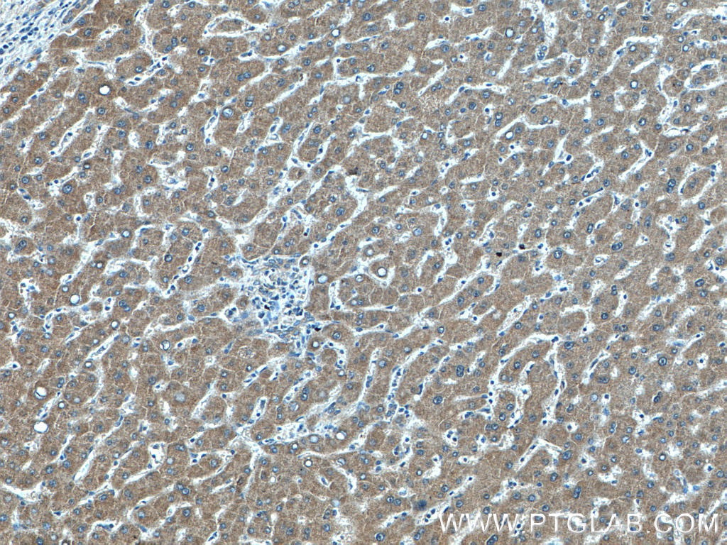 Immunohistochemistry (IHC) staining of human liver cancer tissue using Choline Kinase Alpha Polyclonal antibody (13520-1-AP)