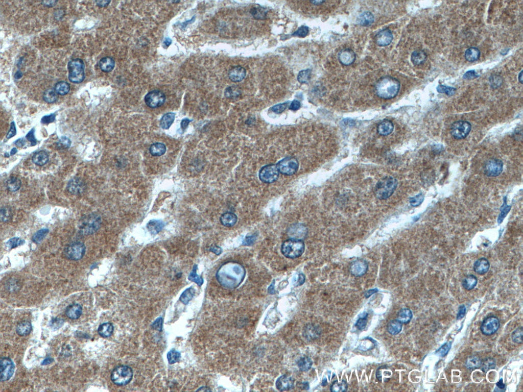 Immunohistochemistry (IHC) staining of human liver cancer tissue using Choline Kinase Alpha Polyclonal antibody (13520-1-AP)