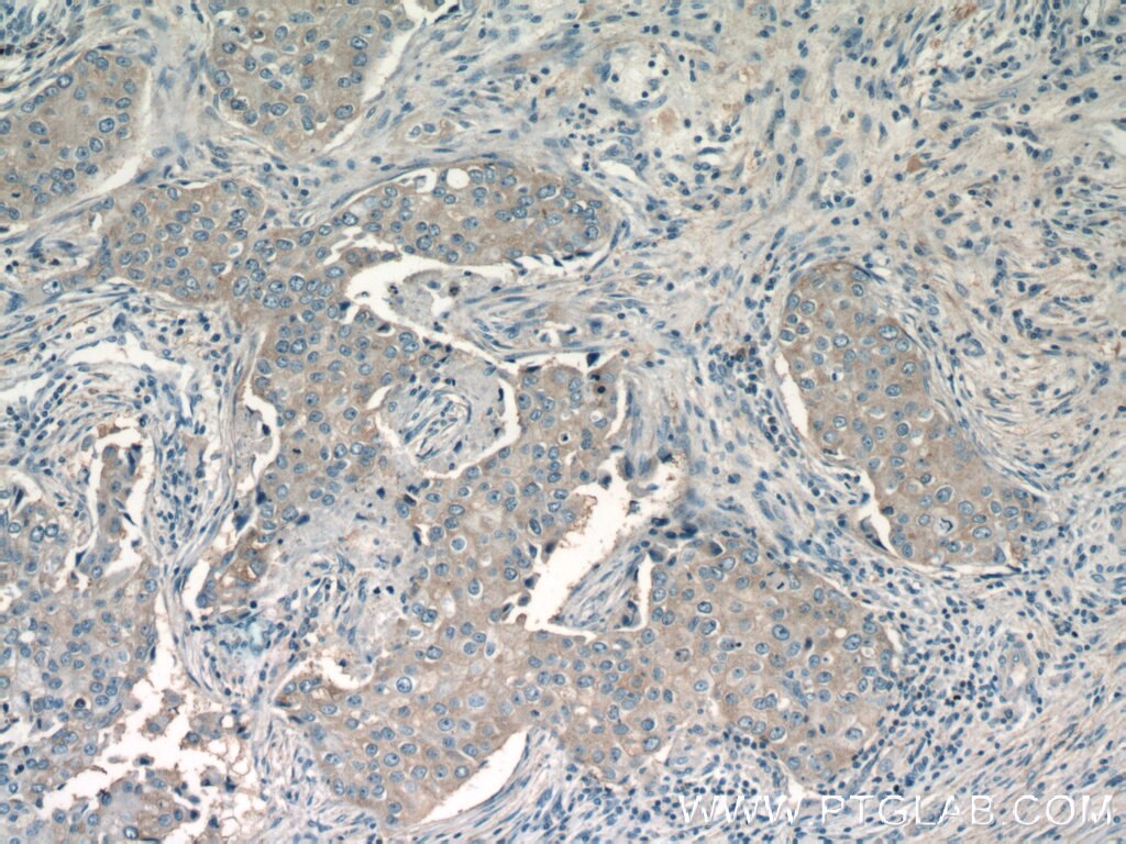 Immunohistochemistry (IHC) staining of human breast cancer tissue using CHKA-Specific Polyclonal antibody (19537-1-AP)