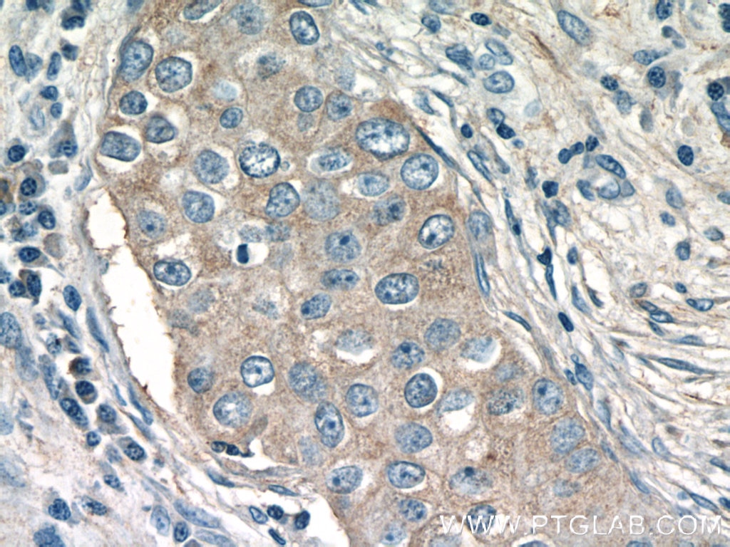 Immunohistochemistry (IHC) staining of human breast cancer tissue using CHKA-Specific Polyclonal antibody (19537-1-AP)