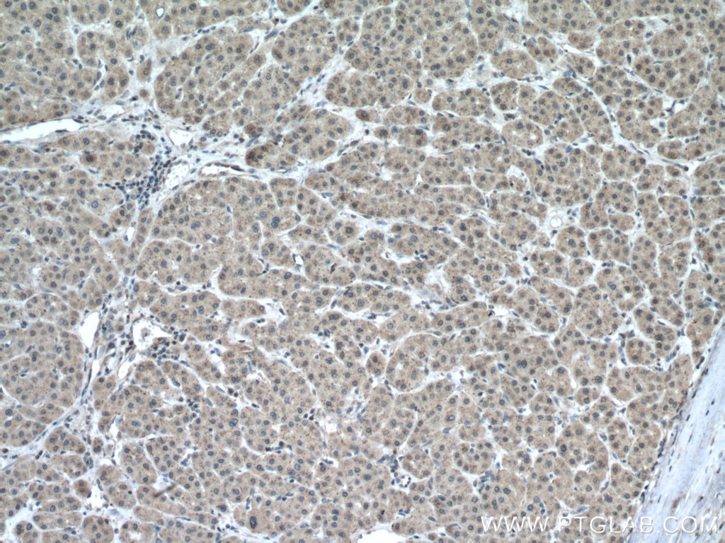 Immunohistochemistry (IHC) staining of human liver cancer tissue using CHMP2A Polyclonal antibody (10477-1-AP)