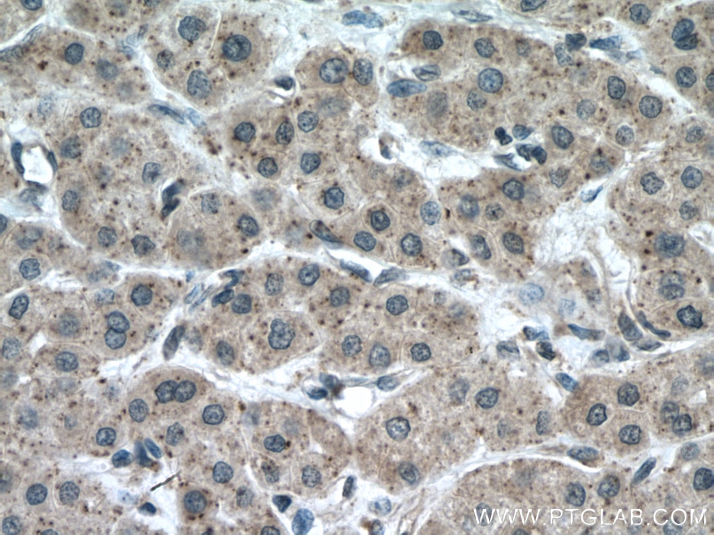 Immunohistochemistry (IHC) staining of human liver cancer tissue using CHMP2A Polyclonal antibody (10477-1-AP)
