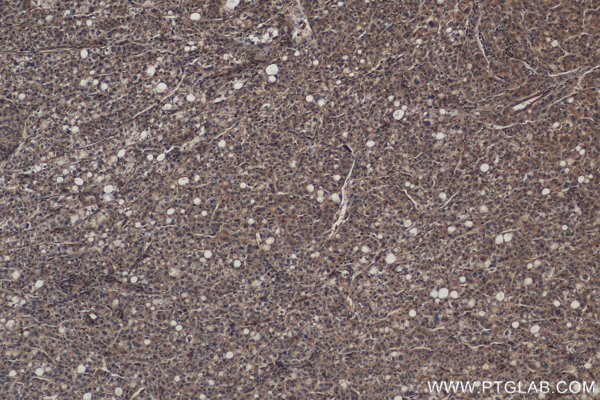 Immunohistochemistry (IHC) staining of human liver cancer tissue using CHMP2B Polyclonal antibody (12527-1-AP)