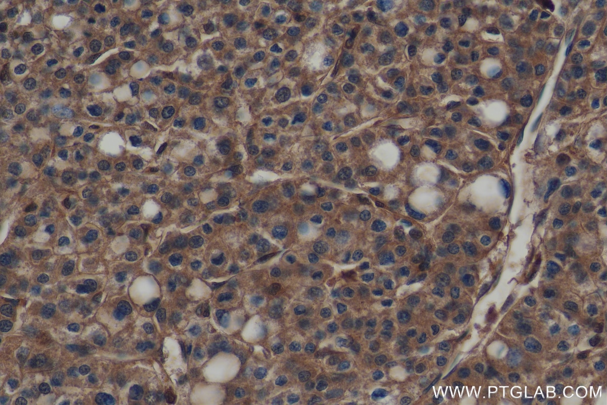 Immunohistochemistry (IHC) staining of human liver cancer tissue using CHMP2B Polyclonal antibody (12527-1-AP)