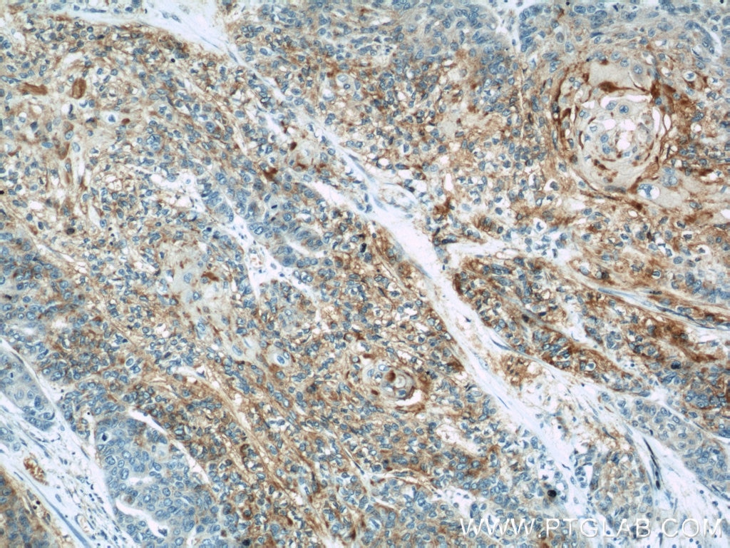 Immunohistochemistry (IHC) staining of human oesophagus cancer tissue using CHMP4B Polyclonal antibody (13683-1-AP)