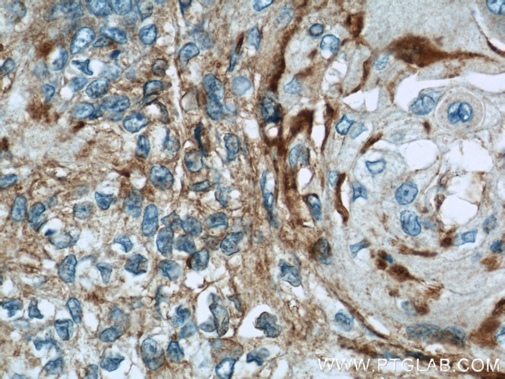 Immunohistochemistry (IHC) staining of human oesophagus cancer tissue using CHMP4B Polyclonal antibody (13683-1-AP)