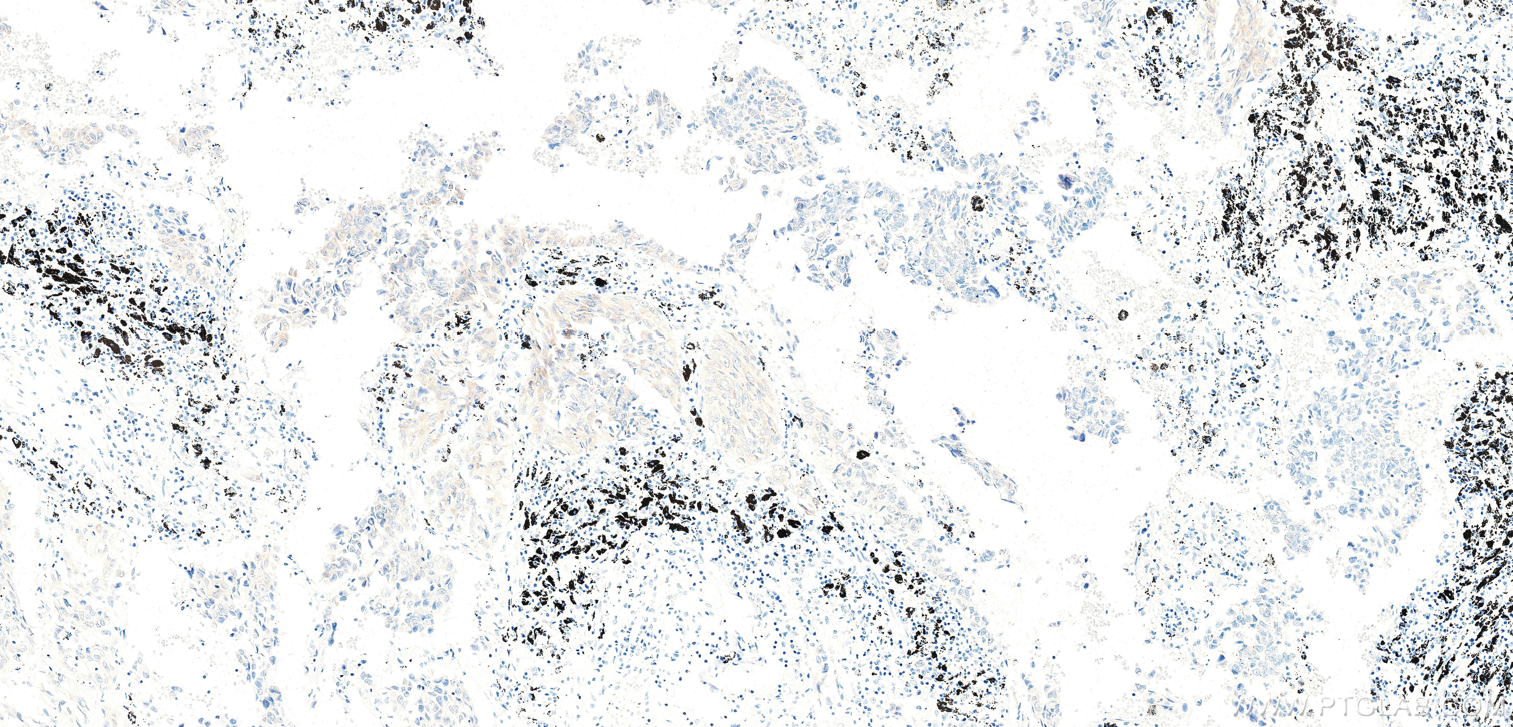 Immunohistochemistry (IHC) staining of Human lung cancer （Adenocarcinoma） using CHMP4C Recombinant monoclonal antibody (87800-1-RR)