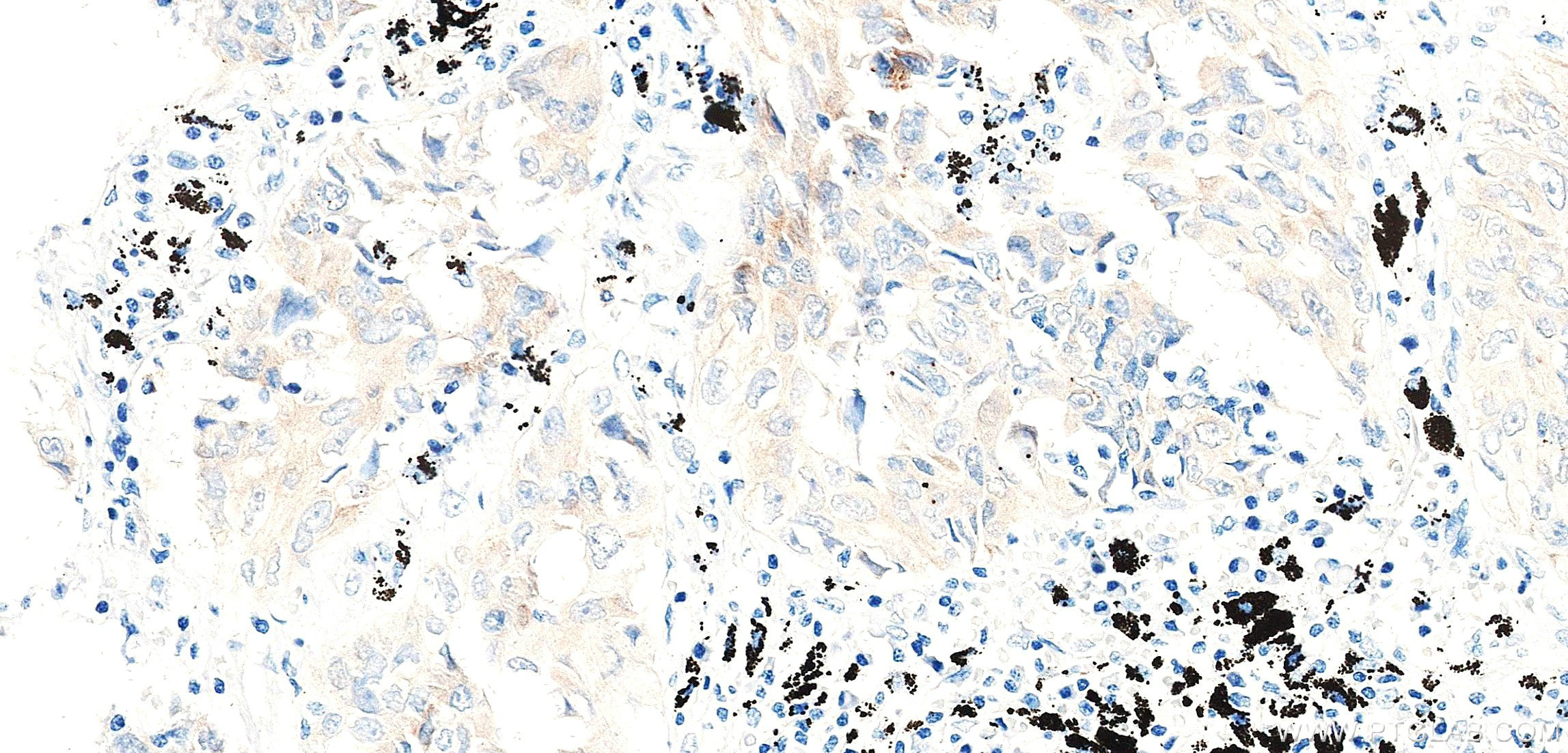 Immunohistochemistry (IHC) staining of Human lung cancer （Adenocarcinoma） using CHMP4C Recombinant monoclonal antibody (87800-1-RR)