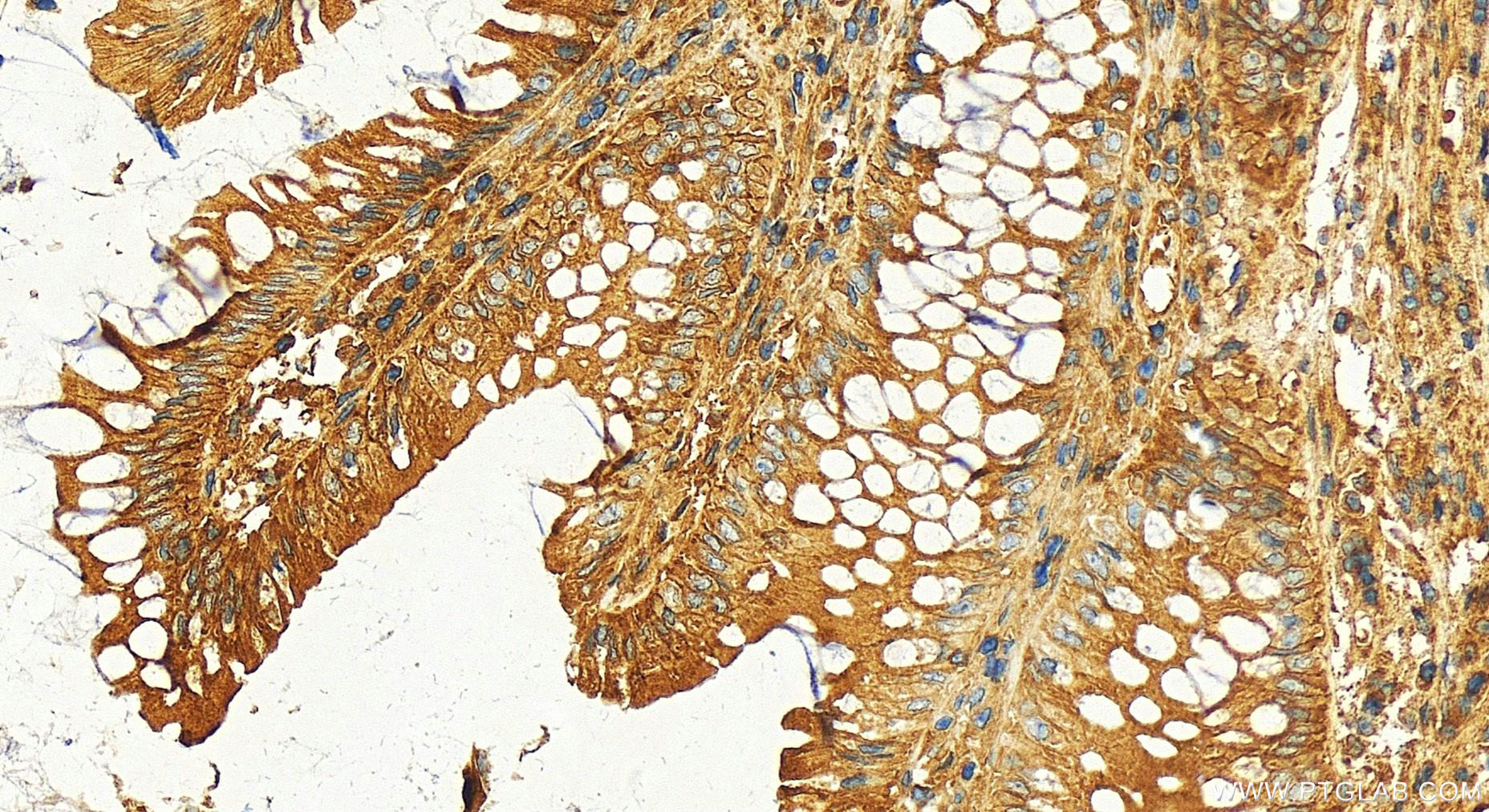 Immunohistochemistry (IHC) staining of human colon  cancer using CHMP6 Polyclonal antibody (16278-1-AP)