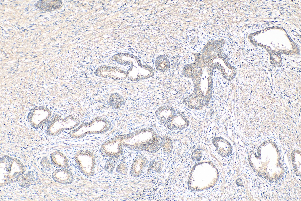 Immunohistochemistry (IHC) staining of human prostate cancer tissue using CHMP7 Monoclonal antibody (68406-1-Ig)