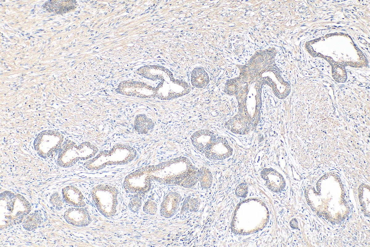 Immunohistochemistry (IHC) staining of human prostate cancer tissue using CHMP7 Monoclonal antibody (68406-1-Ig)