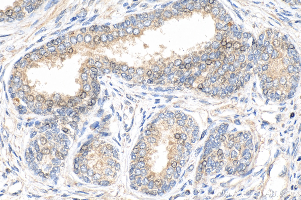 Immunohistochemistry (IHC) staining of human prostate cancer tissue using CHMP7 Monoclonal antibody (68406-1-Ig)