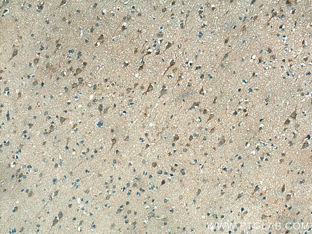 IHC staining of human gliomas using 12048-1-AP