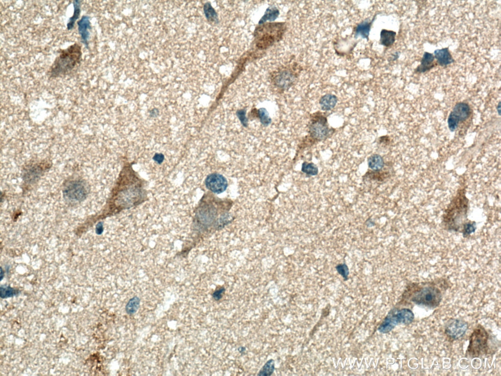 Immunohistochemistry (IHC) staining of human gliomas tissue using CHN1 Polyclonal antibody (12048-1-AP)