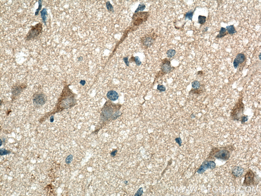 Immunohistochemistry (IHC) staining of human gliomas tissue using CHN1 Polyclonal antibody (12048-1-AP)