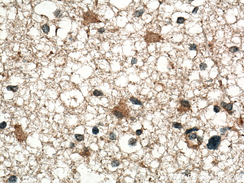 Immunohistochemistry (IHC) staining of human gliomas tissue using CHN1 Polyclonal antibody (12048-1-AP)