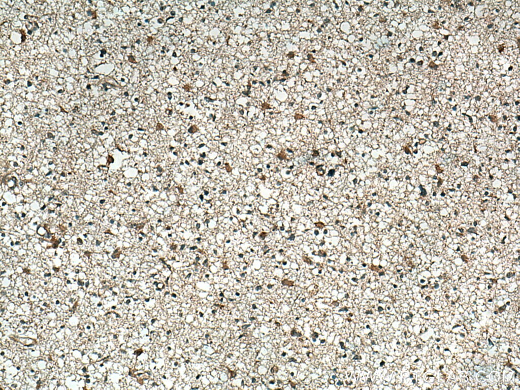 Immunohistochemistry (IHC) staining of human gliomas tissue using CHN1 Polyclonal antibody (12048-1-AP)