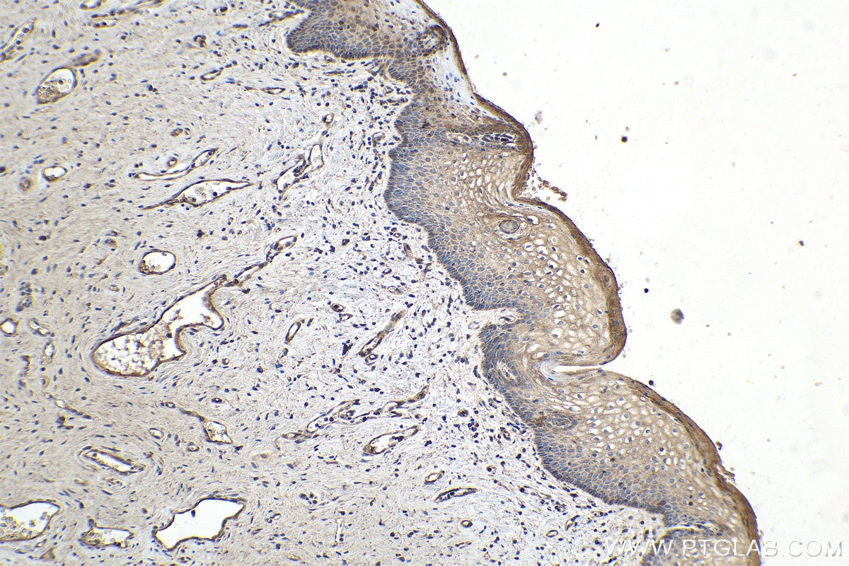 Immunohistochemistry (IHC) staining of human cervical cancer tissue using CHOP; GADD153 Monoclonal antibody (66741-1-Ig)