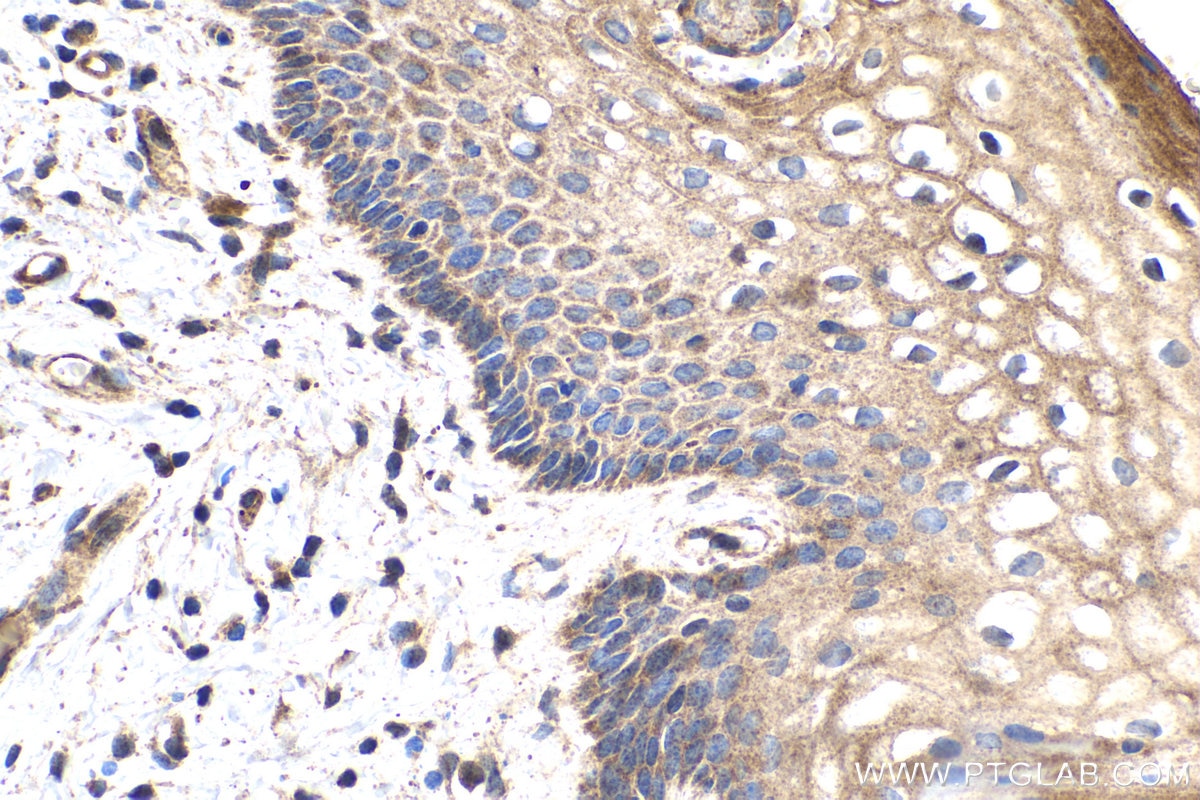 Immunohistochemistry (IHC) staining of human cervical cancer tissue using CHOP; GADD153 Monoclonal antibody (66741-1-Ig)