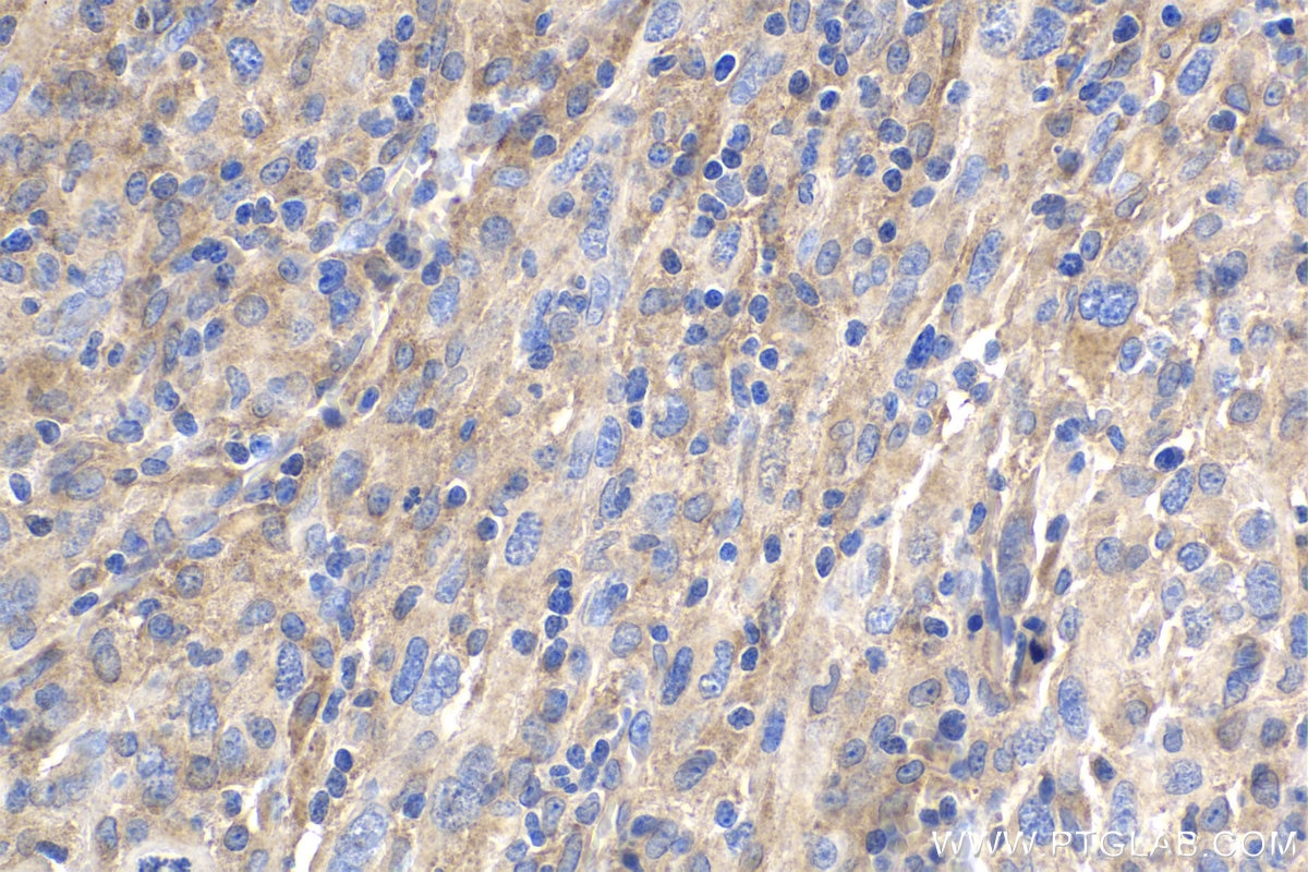 Immunohistochemistry (IHC) staining of human skin cancer tissue using CHOP; GADD153 Monoclonal antibody (66741-1-Ig)