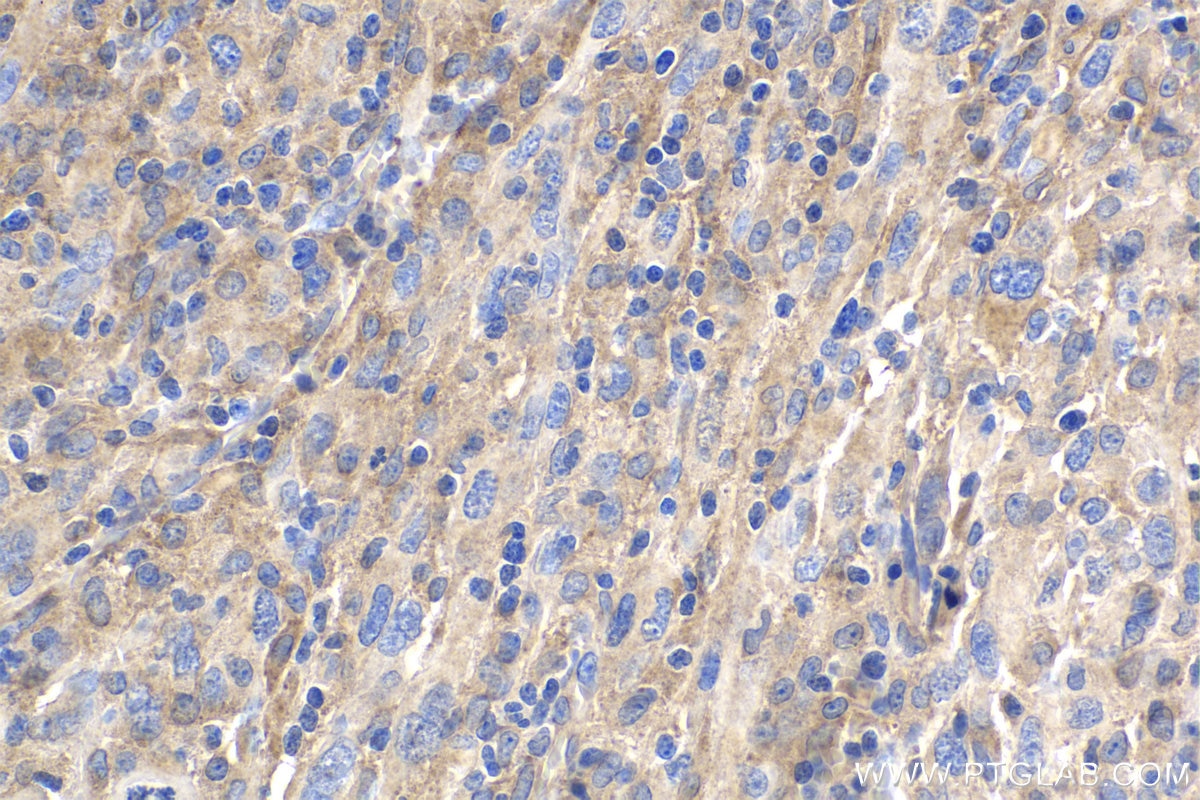 IHC staining of human skin cancer using 66741-1-Ig