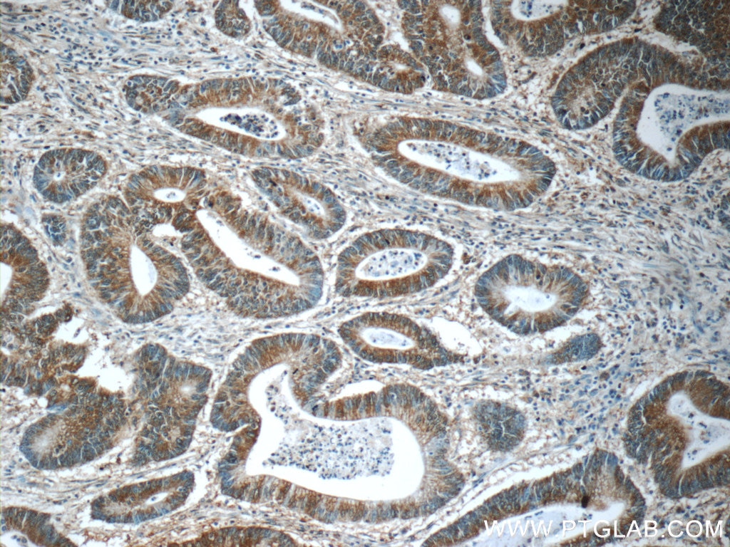 Immunohistochemistry (IHC) staining of human colon cancer tissue using CHPF N-terminal Polyclonal antibody (23953-1-AP)