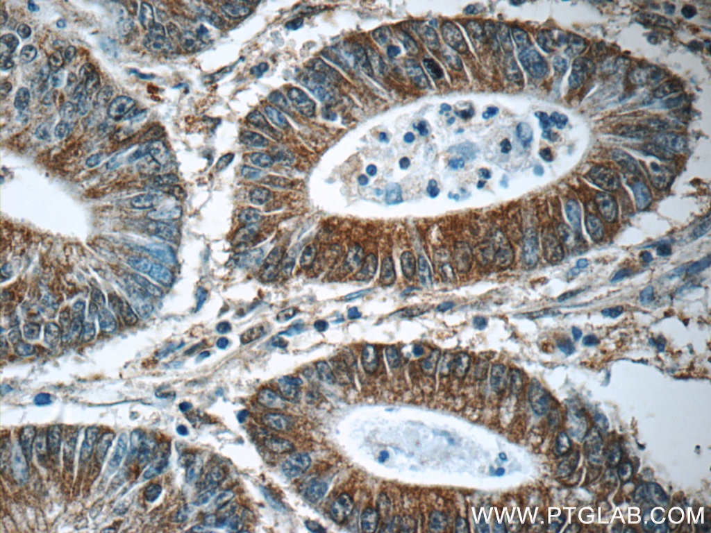 Immunohistochemistry (IHC) staining of human colon cancer tissue using CHPF N-terminal Polyclonal antibody (23953-1-AP)