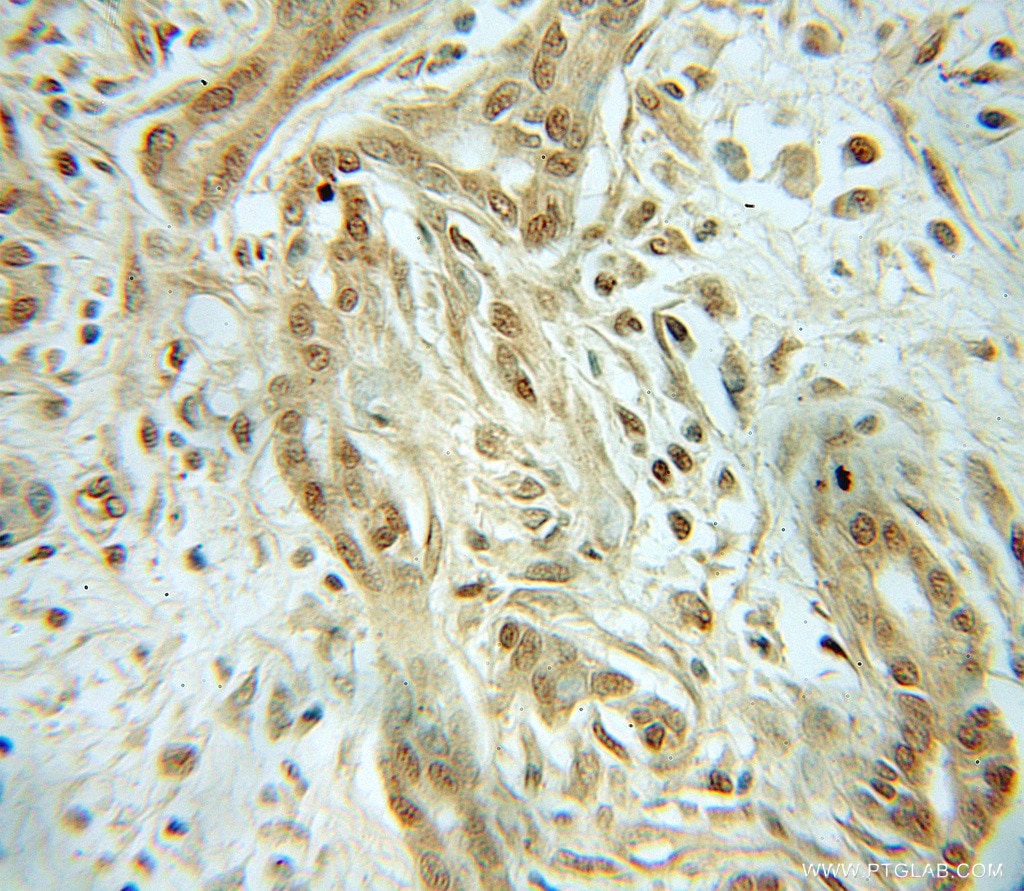 Immunohistochemistry (IHC) staining of human pancreas cancer tissue using CHRAC1 Polyclonal antibody (12126-2-AP)