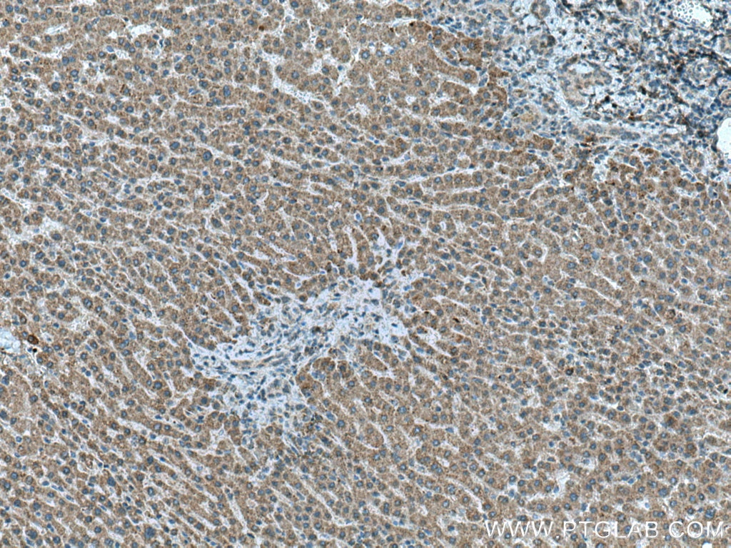 Immunohistochemistry (IHC) staining of human liver cancer tissue using Chordin Polyclonal antibody (27293-1-AP)