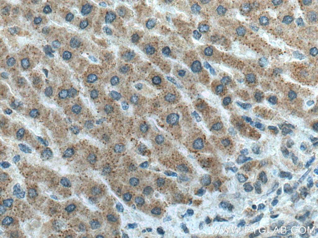 Immunohistochemistry (IHC) staining of human liver cancer tissue using Chordin Polyclonal antibody (27293-1-AP)