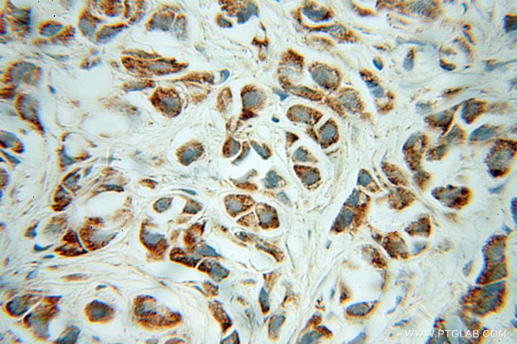 IHC staining of human prostate cancer using 10333-1-AP