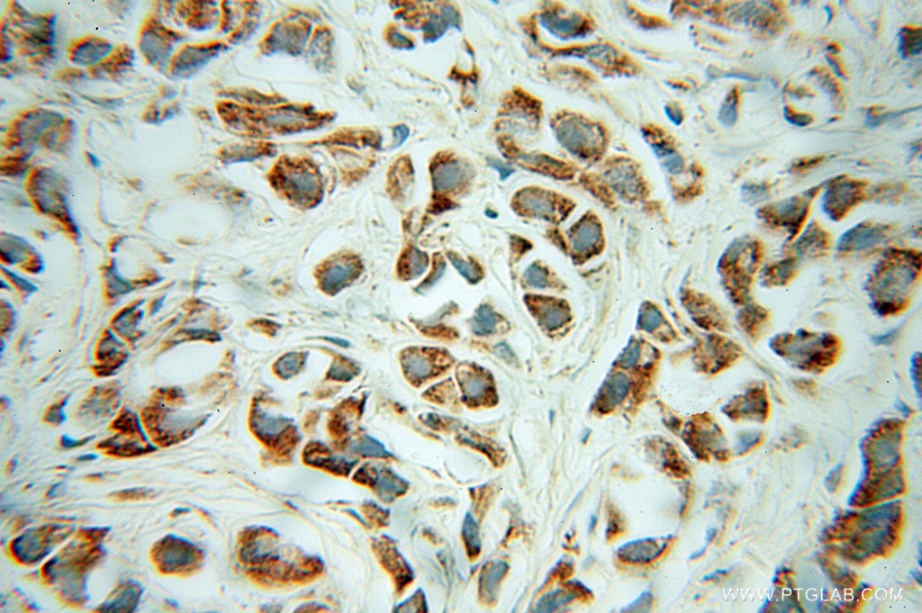 Immunohistochemistry (IHC) staining of human prostate cancer tissue using CHRNA3 Polyclonal antibody (10333-1-AP)