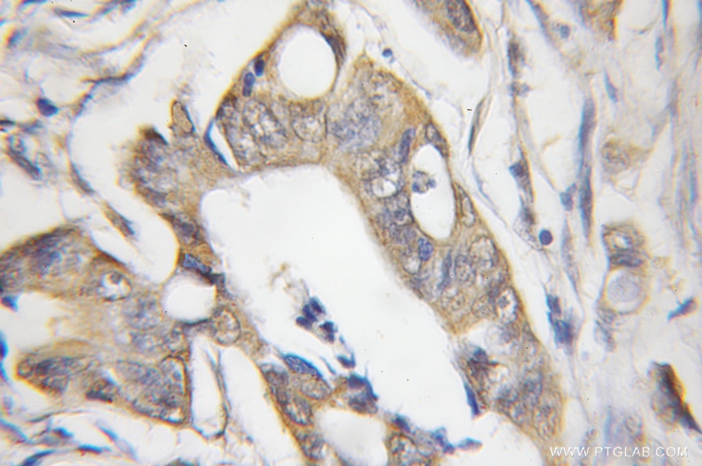 Immunohistochemistry (IHC) staining of human colon cancer tissue using CHRNB1 Polyclonal antibody (11553-1-AP)