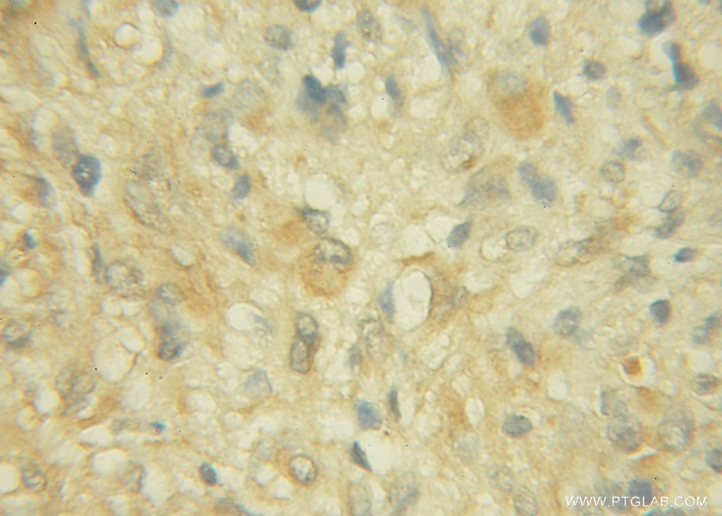 IHC staining of human gliomas using 12013-1-AP