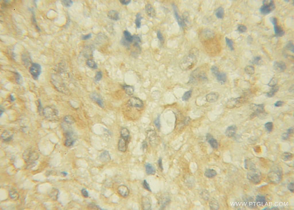 Immunohistochemistry (IHC) staining of human gliomas tissue using CHST10 Polyclonal antibody (12013-1-AP)