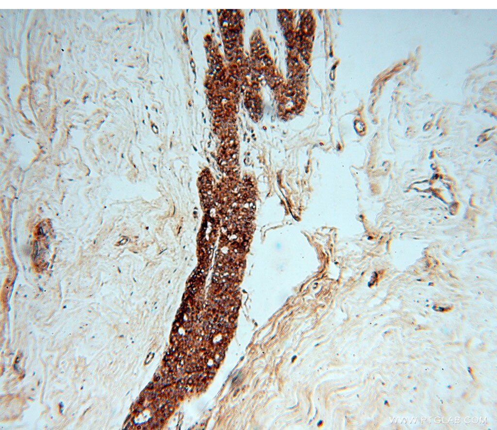 Immunohistochemistry (IHC) staining of human colon cancer tissue using CHST12 Polyclonal antibody (15341-1-AP)