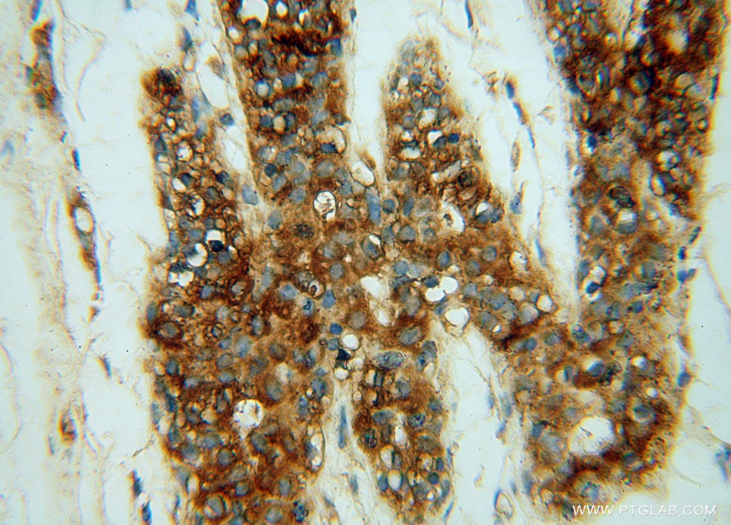 Immunohistochemistry (IHC) staining of human colon cancer tissue using CHST12 Polyclonal antibody (15341-1-AP)