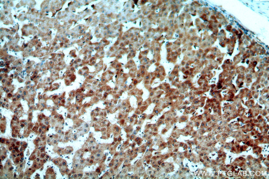 Immunohistochemistry (IHC) staining of human hepatocirrhosis tissue using CHST13-Specific Polyclonal antibody (20141-1-AP)
