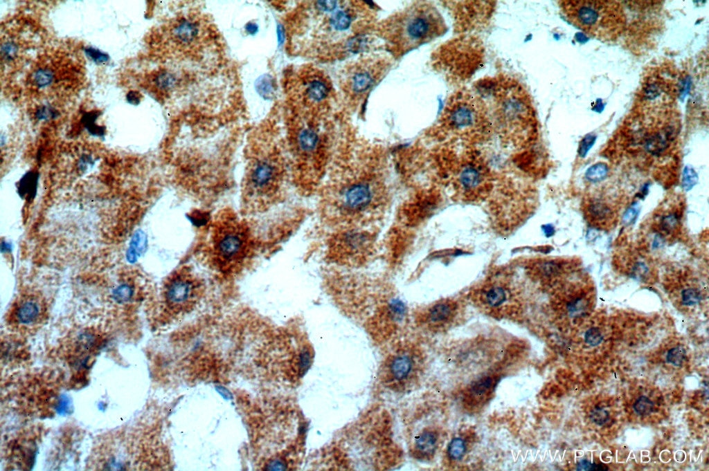 IHC staining of human hepatocirrhosis using 20141-1-AP