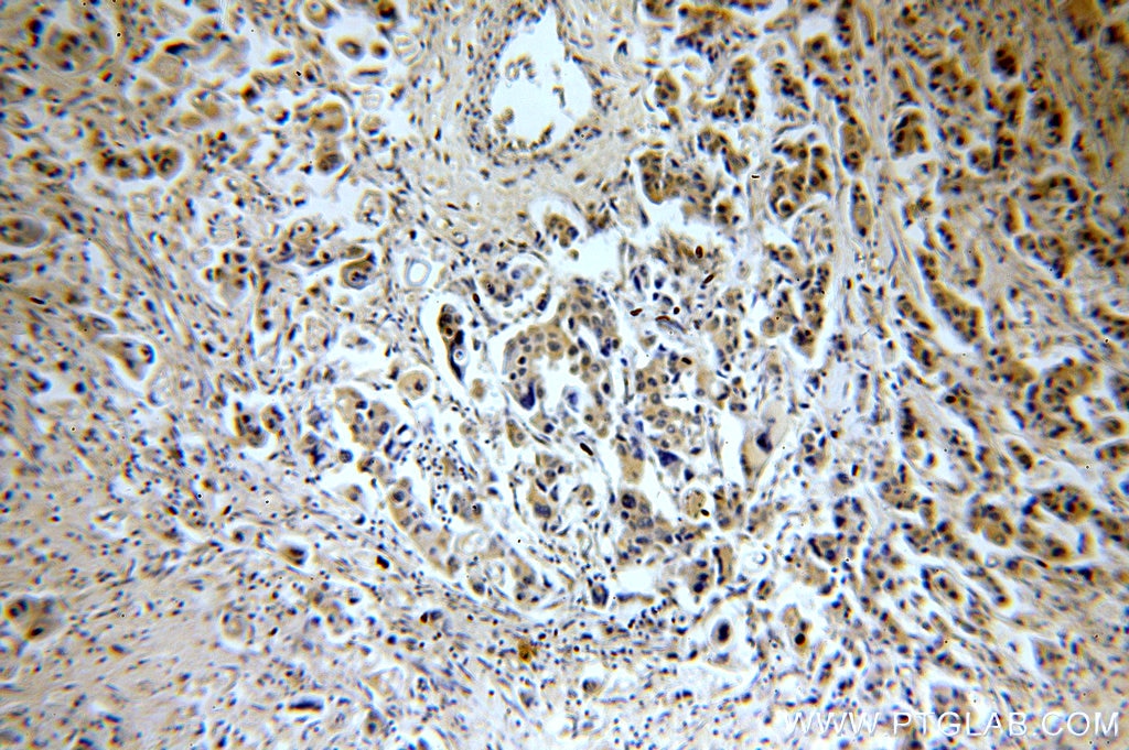 Immunohistochemistry (IHC) staining of human breast cancer tissue using CHST3 Polyclonal antibody (18242-1-AP)