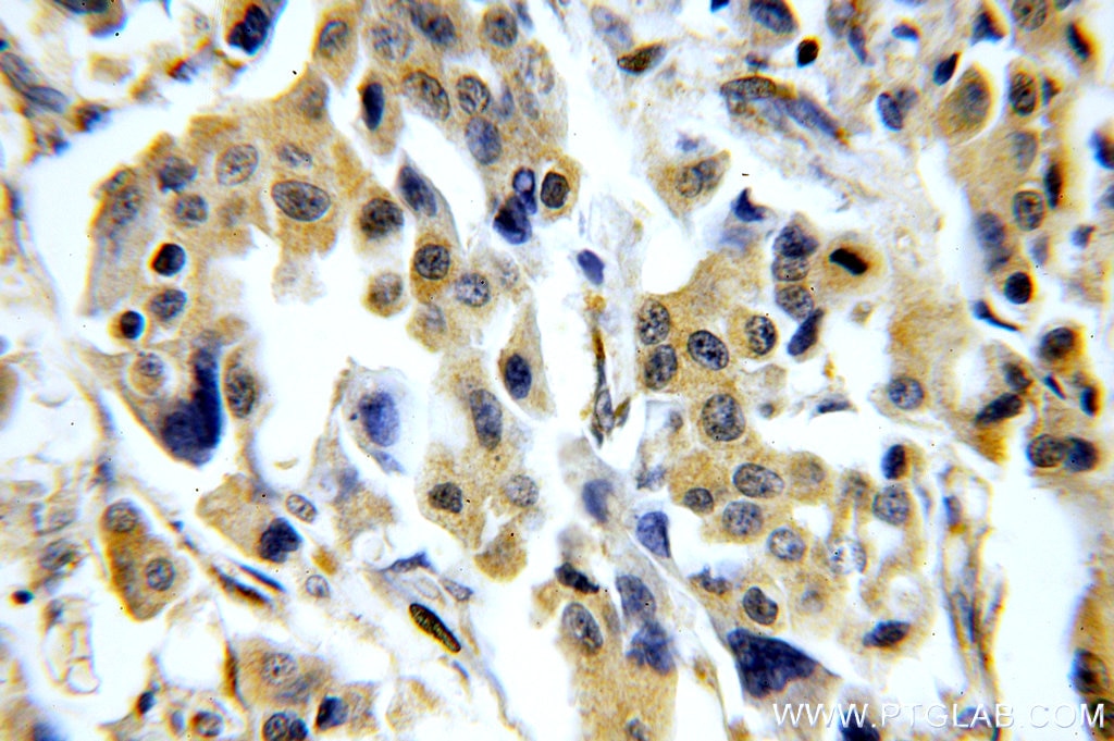 Immunohistochemistry (IHC) staining of human breast cancer tissue using CHST3 Polyclonal antibody (18242-1-AP)