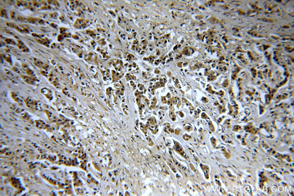 Immunohistochemistry (IHC) staining of human breast cancer tissue using CHST3 Polyclonal antibody (18242-1-AP)