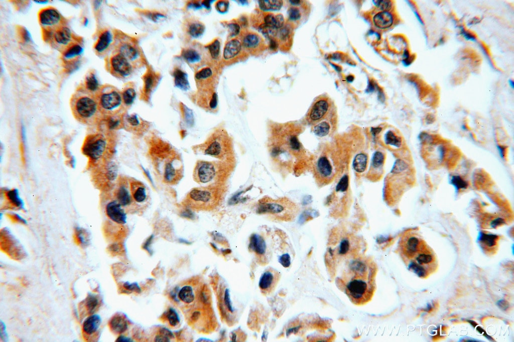 Immunohistochemistry (IHC) staining of human breast cancer tissue using CHST3 Polyclonal antibody (18242-1-AP)