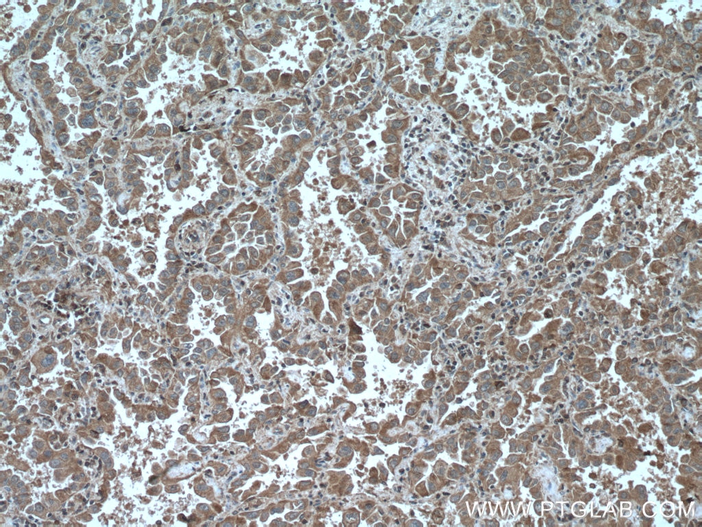 Immunohistochemistry (IHC) staining of human lung cancer tissue using CHST4 Monoclonal antibody (66623-1-Ig)